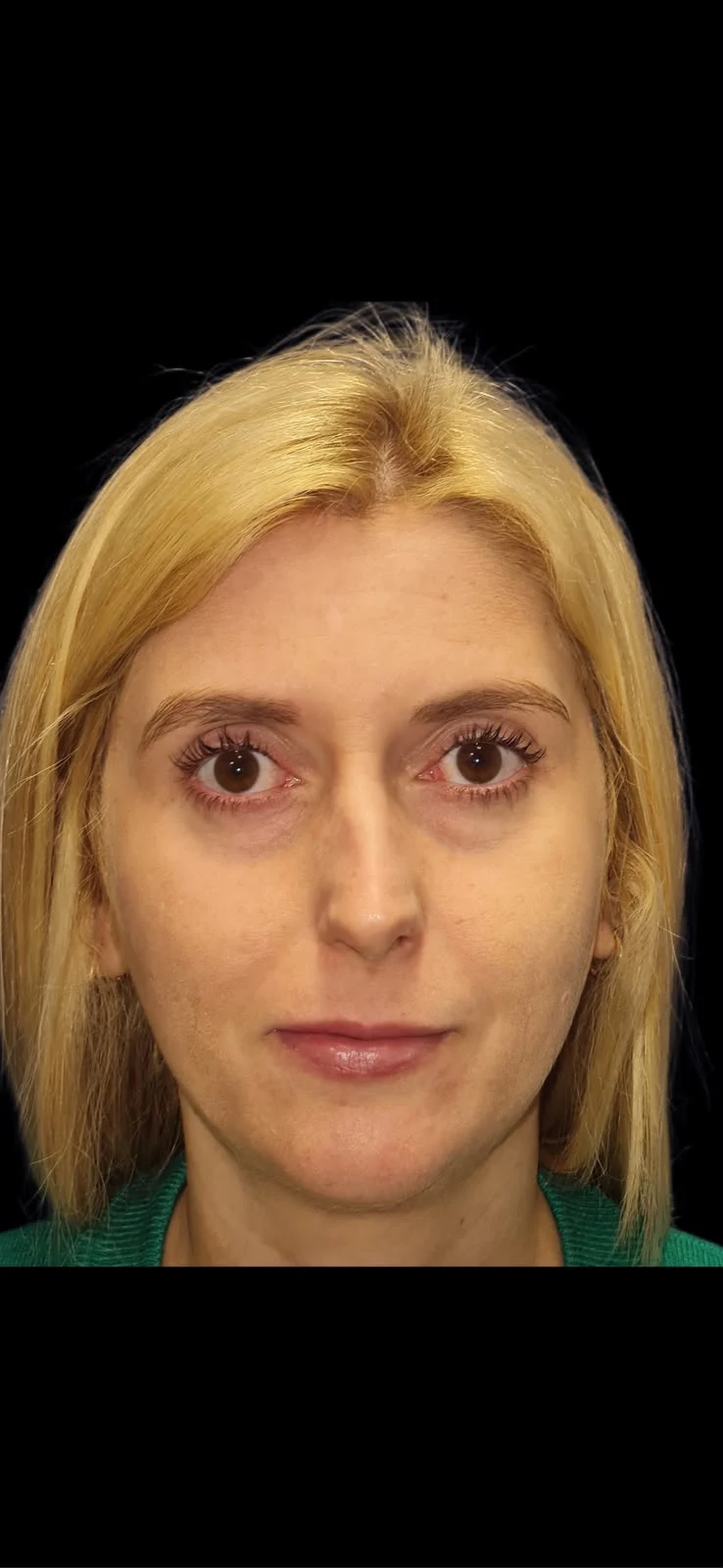 Fotografia clínica frontal do caso 1 de rinoplastia, antes do procedimento.