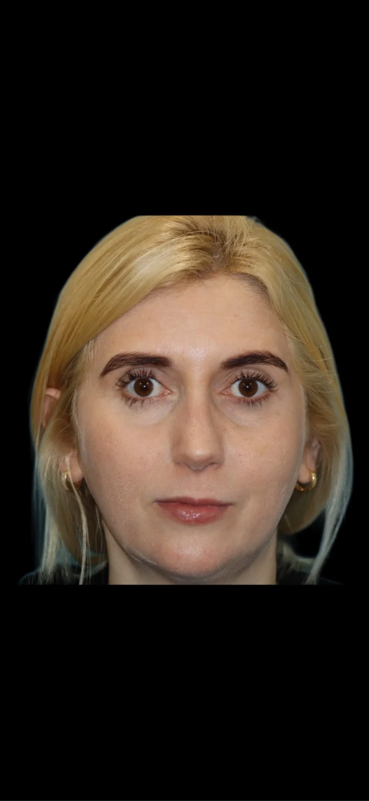 Fotografia clínica frontal do caso 1 de rinoplastia, depois do procedimento.