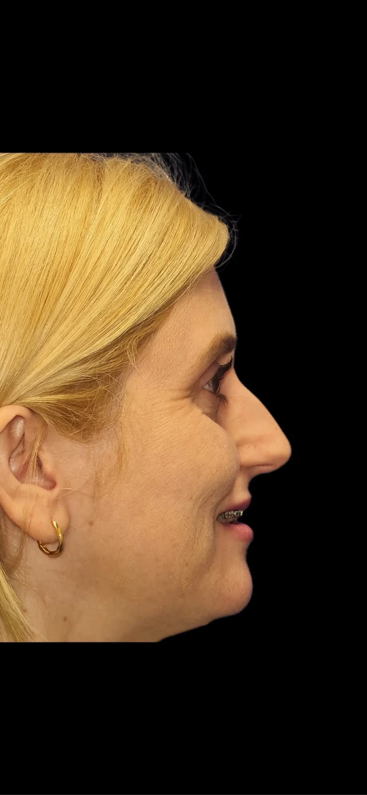 Fotografia clínica em perfil do caso 2 de rinoplastia, antes do procedimento.