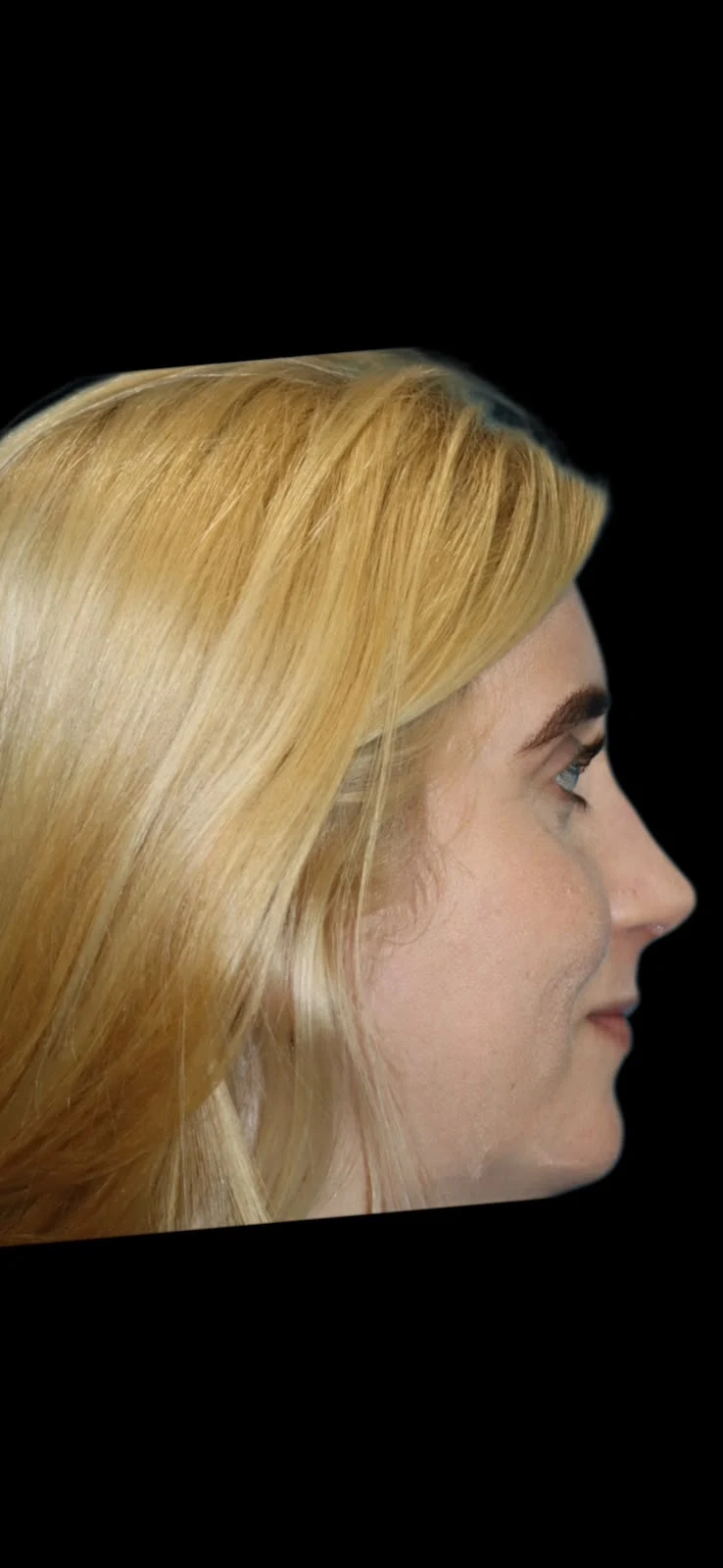 Fotografia clínica em perfil do caso 2 de rinoplastia, depois do procedimento.
