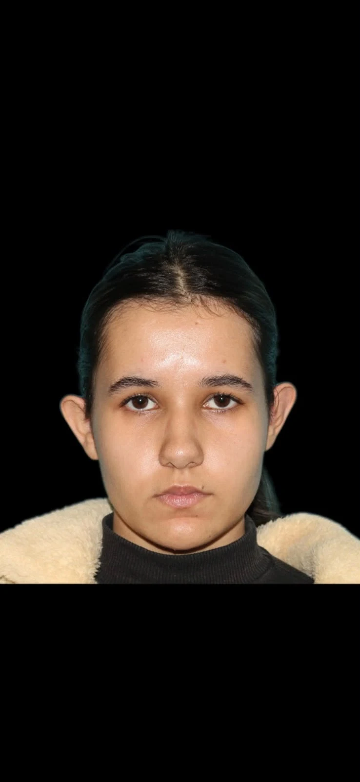 Fotografia clínica frontal do caso 3 de otoplastia, antes do procedimento.