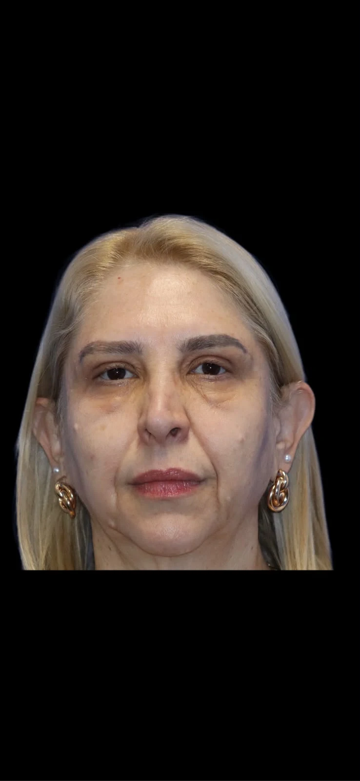 Fotografia clínica frontal do caso 4 de blefaroplastia, depois do procedimento.