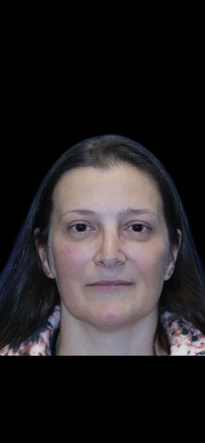 Fotografia clínica frontal do caso 5 de blefaroplastia, depois do procedimento.