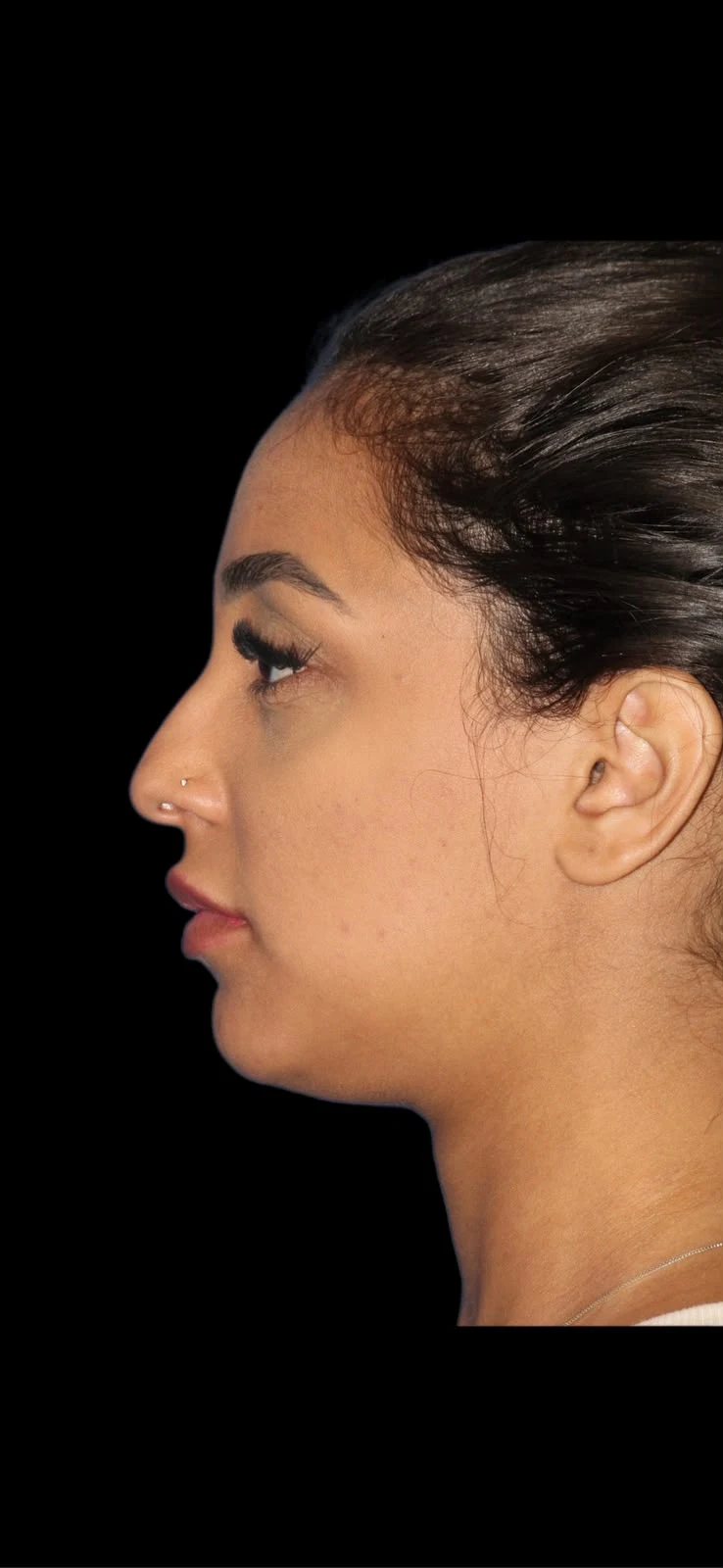 Fotografia clínica em perfil do caso 6 de rinoplastia, antes do procedimento.