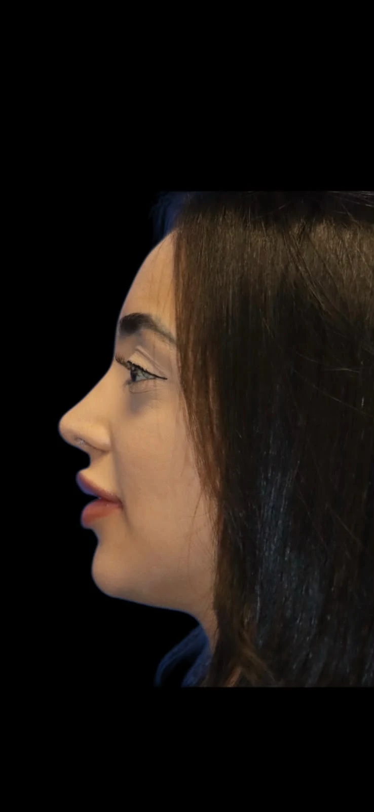 Fotografia clínica em perfil do caso 6 de rinoplastia, depois do procedimento.